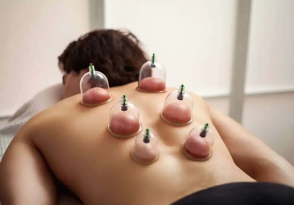 cupping